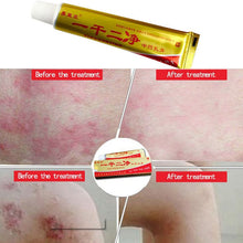 15 g Useful Mint Eczema Psoriasis chronic dermatitis Ointment Antibacteria Creams UBY