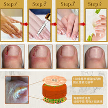 A quality Fungal Nail Treatment Essence Nail and Foot Whitening Toe Nail Fungus Removal Feet Care Nail Gel UBY